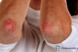 Таблетки от псориатического артрита