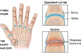 Псориаз на руках: как выявить и лечить заболевание