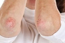Почему кожа на пальце руки трескается?