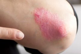 Методы диагностики и лечения псориаза в израильских клиниках
