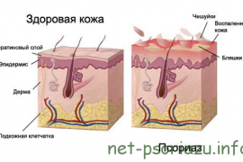 Псориаз у детей