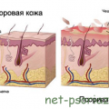 История болезни псориаз