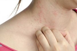 Фото начальной стадии псориаза, первые симптомы заболевания и его лечение