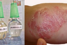 Как лечить псориаз водой: эффективные методы избавления от сыпи