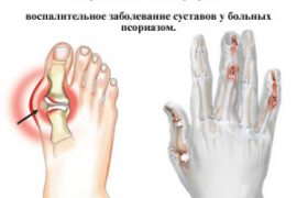 Анализ крови при псориатическом артрите