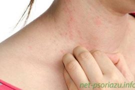Как вылечить псориаз в домашних условиях