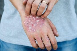 В чем заключается разница между псориазом и экземой?