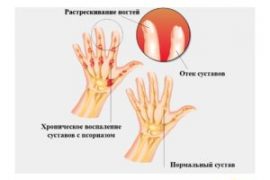 Как лечить артрит?