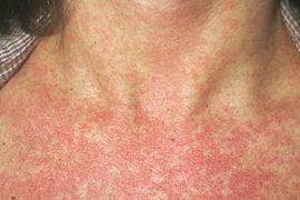 Сыпь на теле на нервной почве: причины, фото, лечение