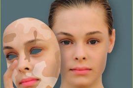 Чем лечить псориаз на руках?