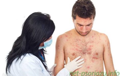 Все о псориазе и современных методах лечения болезни
