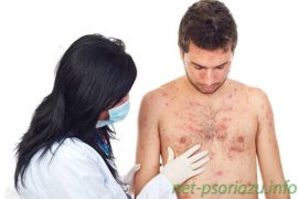 Фото начальной стадии псориаза, первые симптомы заболевания и его лечение