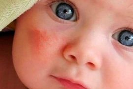 Атопический дерматит у детей