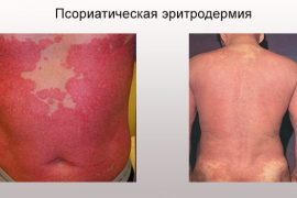 Признаки псориатической эритродермии на коже
