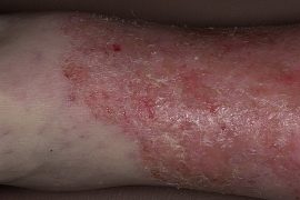 Psorifort (Псорифорт) от псориаза