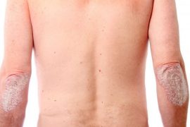 Лечение прогрессирующей и стационарной стадии псориаза