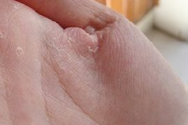 Чем лечить экзему на руках: лечение мазями, препаратами, народными средствам