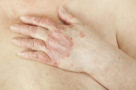 Псориаз у мужчин влияет на потенцию
