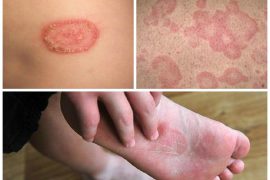 Отличие псориаза от кожных заболеваний и дерматита