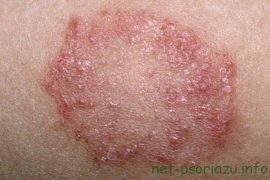 Как избавиться от псориаза на ногтях в домашних условиях