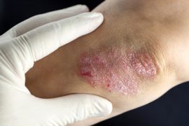 От чего появляется псориаз на локтях и народные способы его лечения