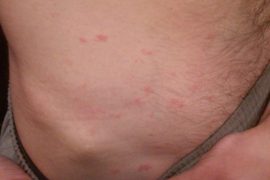 Красные пятна на теле: виды, причины, лечение