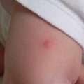 Красные пятна на теле у взрослого