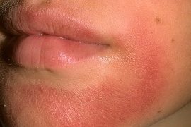 Какими мазями лечить псориаз на ногах
