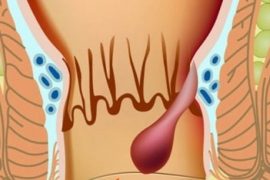 3 способа лечения геморроя при обострении