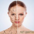 АСД при псориазе: лечение фракцией и отзывы