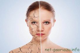 Как быстро снять обострение псориаза: медицинские и народные методы решения проблемы