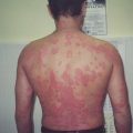 Причины, симптомы, диагностика и лечение псориаза на лице. Как выглядит болезнь на фото?