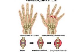 Диета при артрите