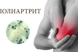 Полиартрит: причины, симптомы, диагностика и лечение