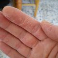 Псориаз на руках: симптомы и лечение
