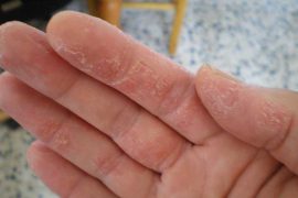 Псориаз на руках: симптомы и лечение