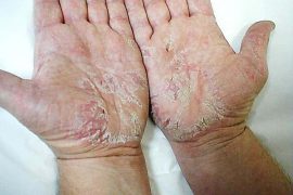 Эффективные витамины при псориазе