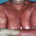 Можно ли вылечить псориаз навсегда