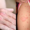 Псориаз у взрослых: причины, симптомы, лечение