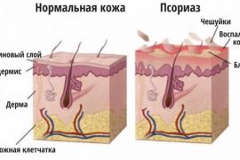 Есть ли препарат от псориаза