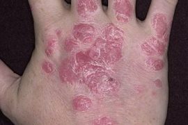 Лечение псориаза фракциями АСД 2 и АСД 3