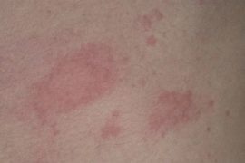 Как лечить псориаз в домашних условиях: лекарственные и народные методы