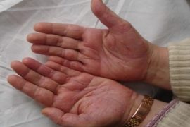 Фото начальной стадии псориаза, первые симптомы заболевания и его лечение