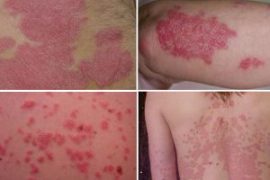 Лечение псориаза мазями: отзывы пациентов