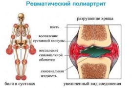 Псориатический артрит – загадочное и непредсказуемое заболевание. Основные методы диагностики и лечения