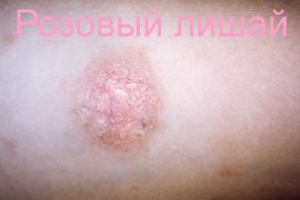 Розовый лишай у человека