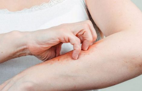 Заразен ли псориаз для окружающих?