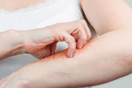 Что за болезнь псориаз, как она проявляется и как лечится