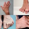 Симптомы и лечение псориатического артрита