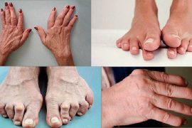 Симптомы и лечение псориатического артрита